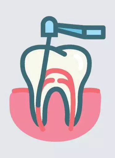 Root Canals